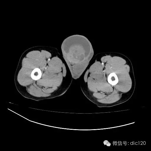 【病例】右侧睾丸精原细胞瘤一例 【病例】右侧睾丸精原细胞瘤一例