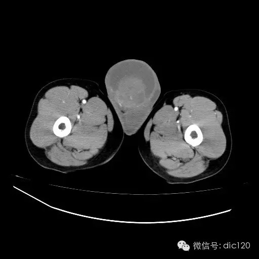 【病例】右侧睾丸精原细胞瘤一例 【病例】右侧睾丸精原细胞瘤一例