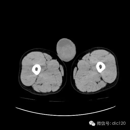 【病例】右侧睾丸精原细胞瘤一例 【病例】右侧睾丸精原细胞瘤一例