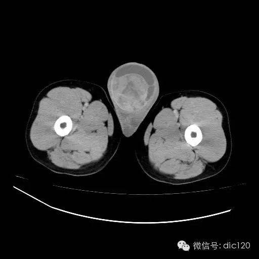 【病例】右侧睾丸精原细胞瘤一例 【病例】右侧睾丸精原细胞瘤一例