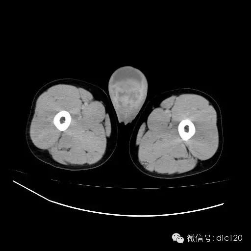 【病例】右侧睾丸精原细胞瘤一例 【病例】右侧睾丸精原细胞瘤一例