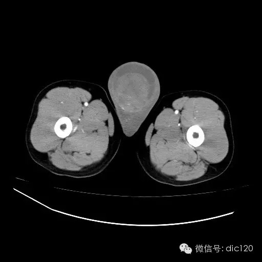 【病例】右侧睾丸精原细胞瘤一例 【病例】右侧睾丸精原细胞瘤一例