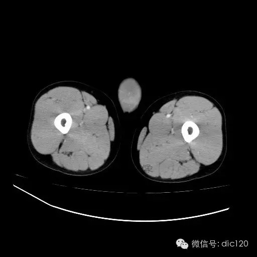 【病例】右侧睾丸精原细胞瘤一例 【病例】右侧睾丸精原细胞瘤一例