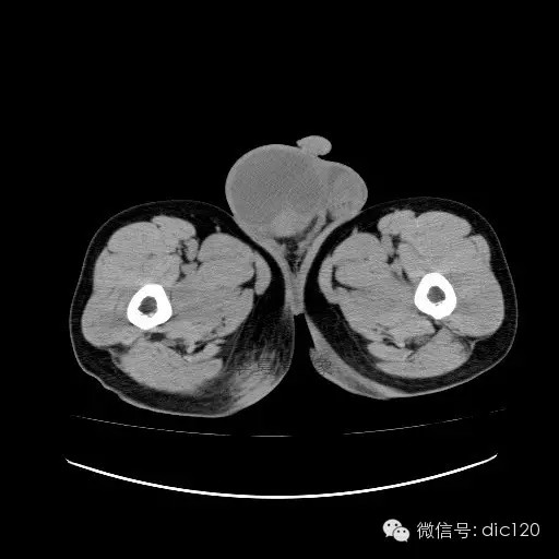 【病例】右侧睾丸精原细胞瘤一例 【病例】右侧睾丸精原细胞瘤一例