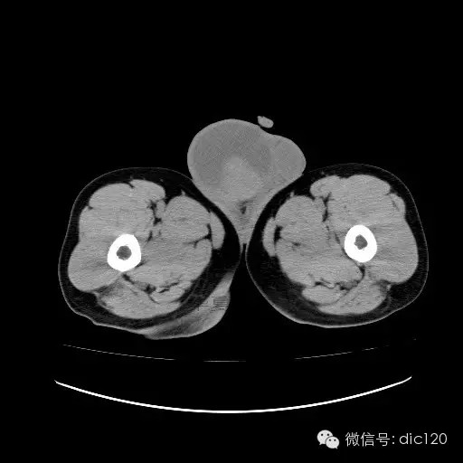 【病例】右侧睾丸精原细胞瘤一例 【病例】右侧睾丸精原细胞瘤一例
