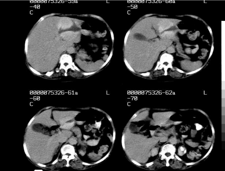 肝胆胰脾影像诊断学