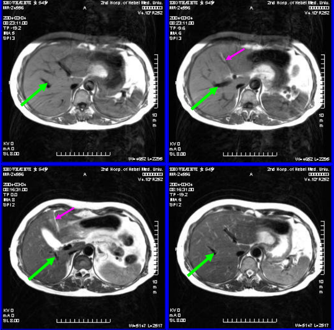 肝胆胰脾影像诊断学