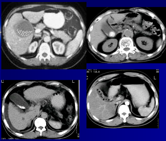 肝胆胰脾影像诊断学