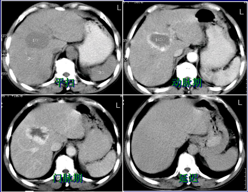 肝胆胰脾影像诊断学