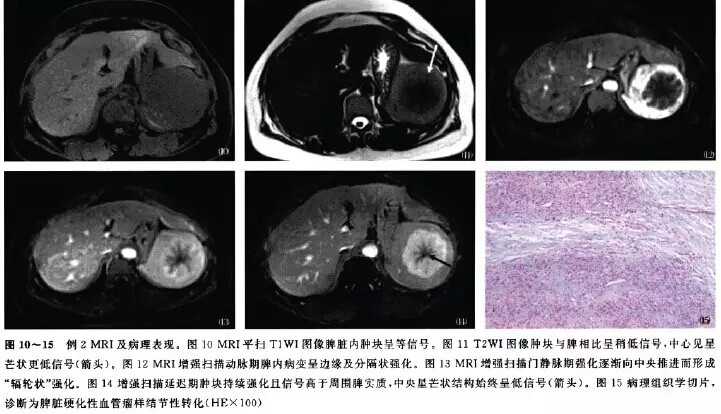 【病例】脾硬化性血管瘤样结节性转化的影像学表现2例