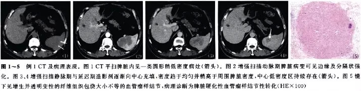脾硬化性血管瘤样结节性转化的影像学表现2例