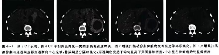 【病例】脾硬化性血管瘤样结节性转化的影像学表现2例
