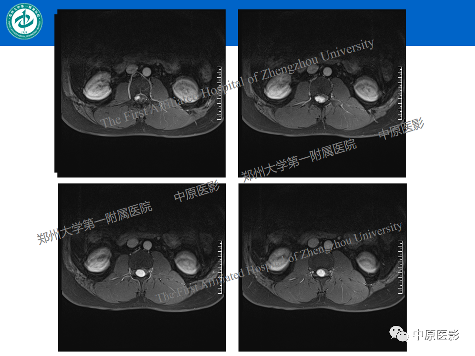 【病例】腰椎毛细血管瘤1例MR影像-10