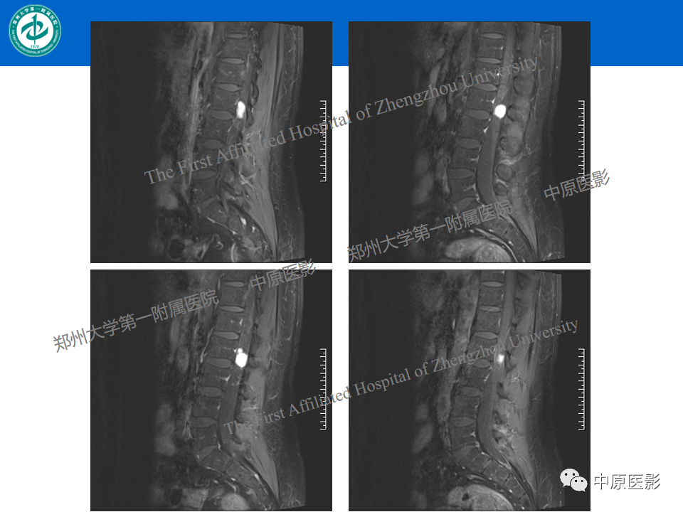 【病例】腰椎毛细血管瘤1例MR影像-8