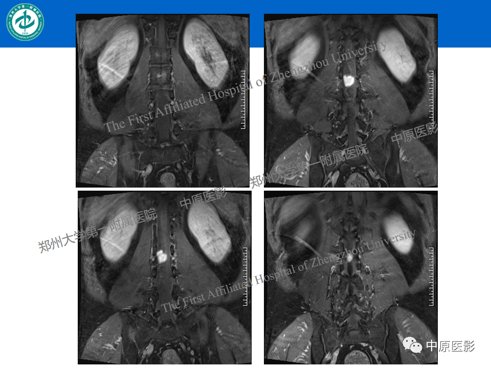 【病例】腰椎毛细血管瘤1例MR影像-9