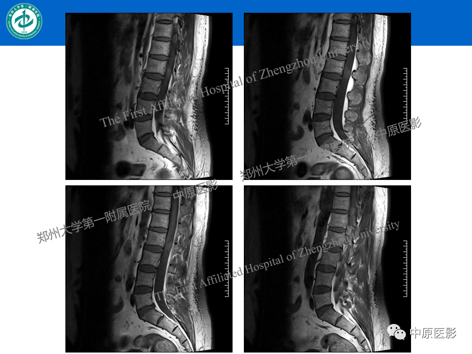 【病例】腰椎毛细血管瘤1例MR影像-3