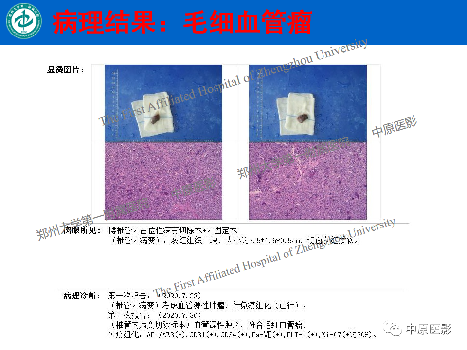 【病例】腰椎毛细血管瘤1例MR影像-14