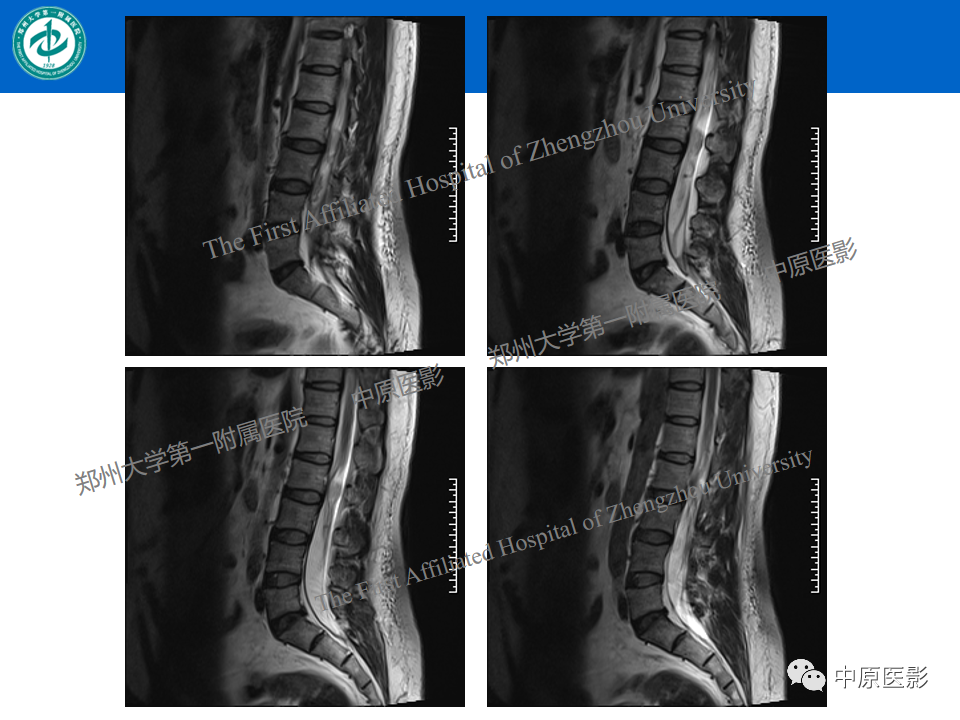 【病例】腰椎毛细血管瘤1例MR影像-4