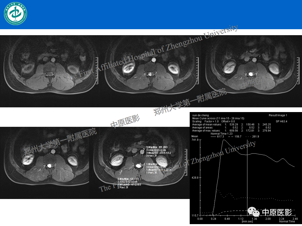 【病例】腰椎毛细血管瘤1例MR影像-7