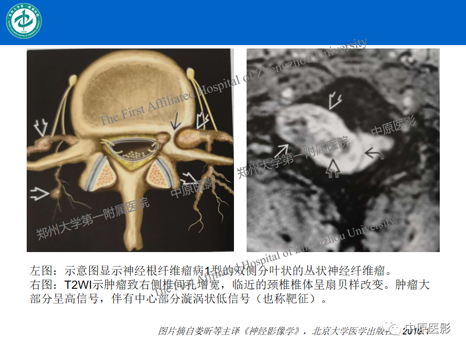 【病例】腰椎毛细血管瘤1例MR影像-22