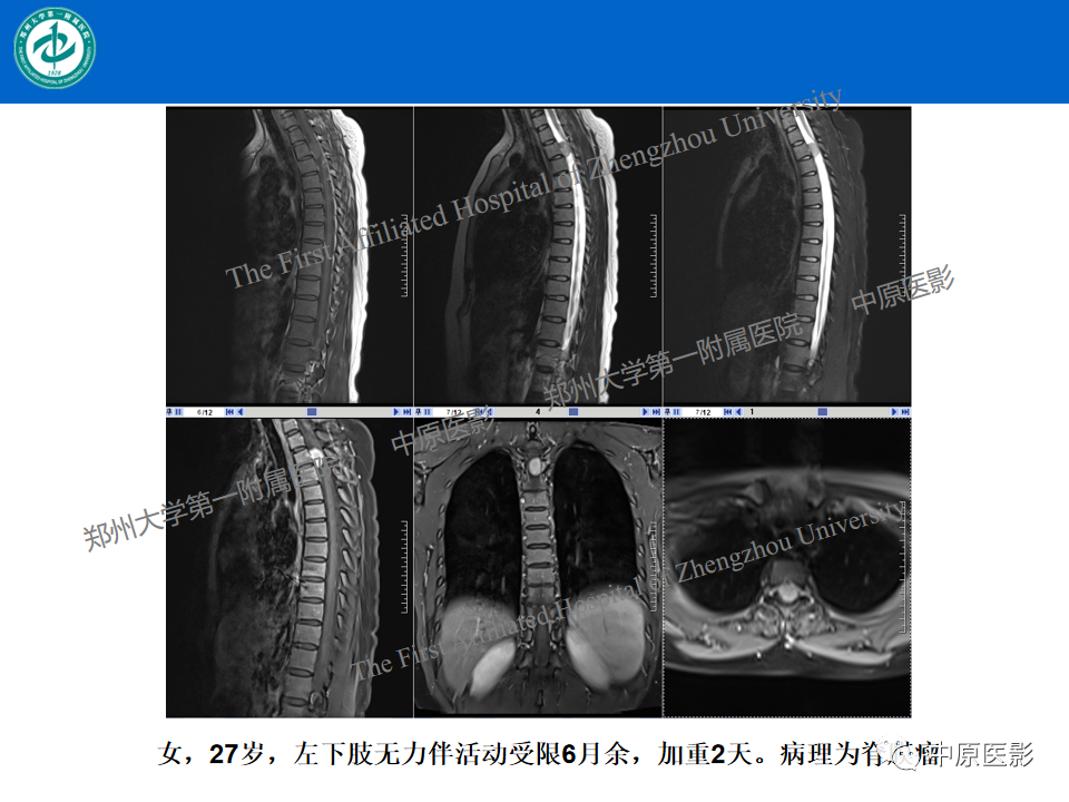 【病例】腰椎毛细血管瘤1例MR影像-24