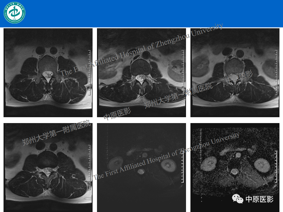 【病例】腰椎毛细血管瘤1例MR影像-6
