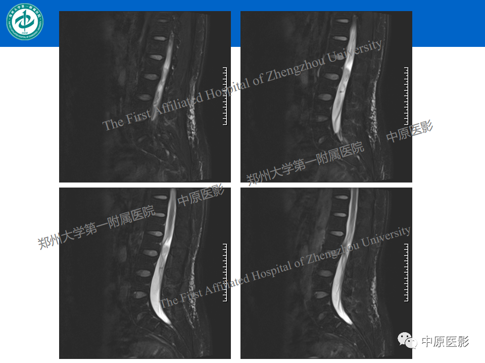 【病例】腰椎毛细血管瘤1例MR影像-5
