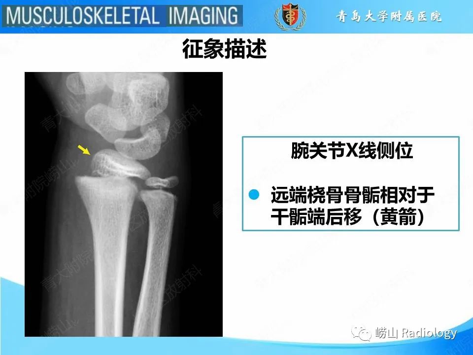 【PPT】索尔特骨折-20
