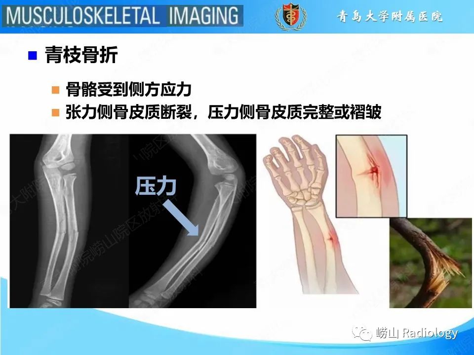 【PPT】索尔特骨折-11