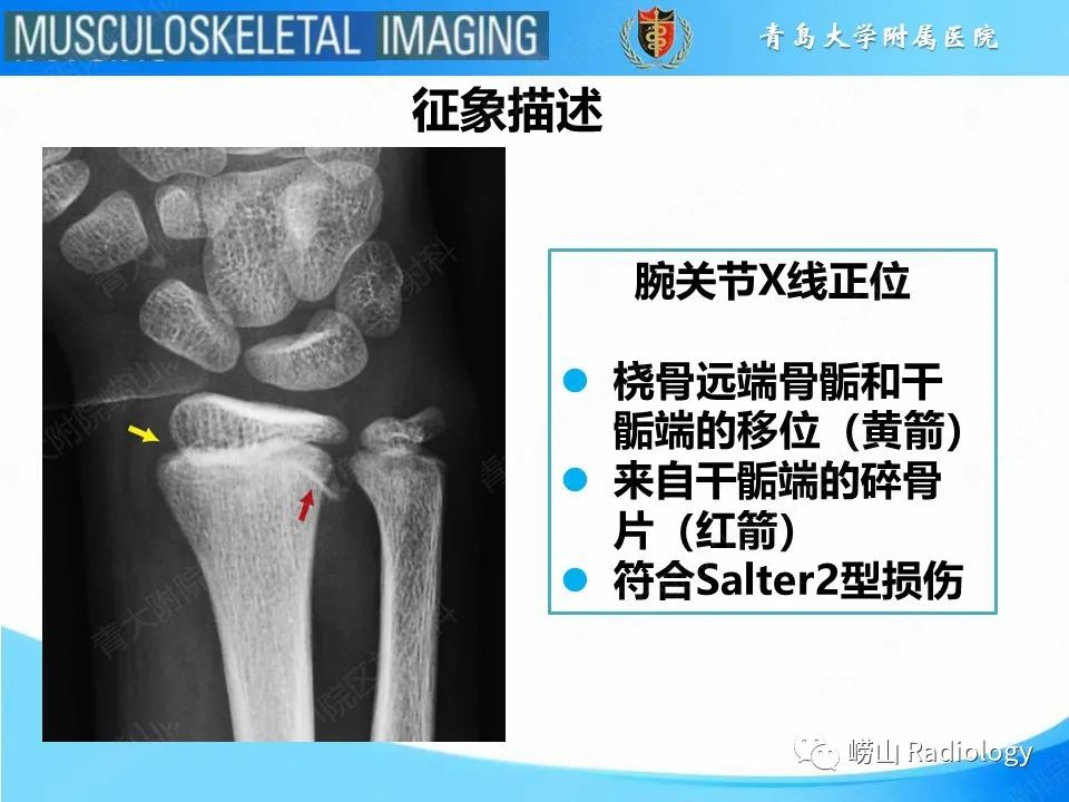 【PPT】索尔特骨折-19