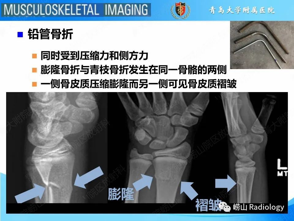 【PPT】索尔特骨折-13