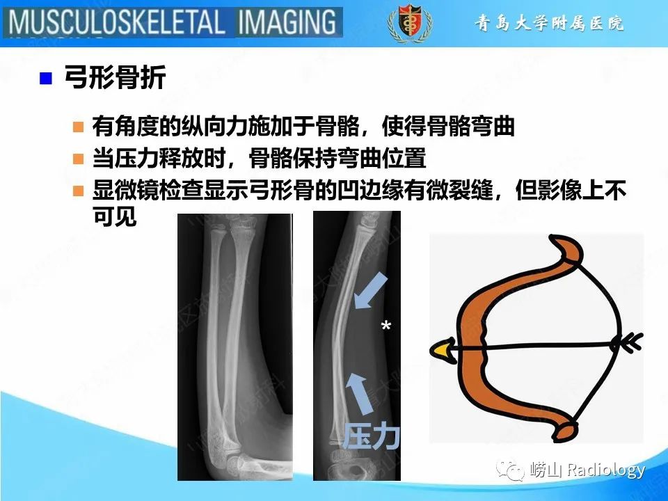 【PPT】索尔特骨折-14