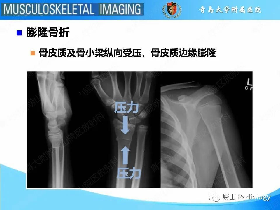 【PPT】索尔特骨折-12