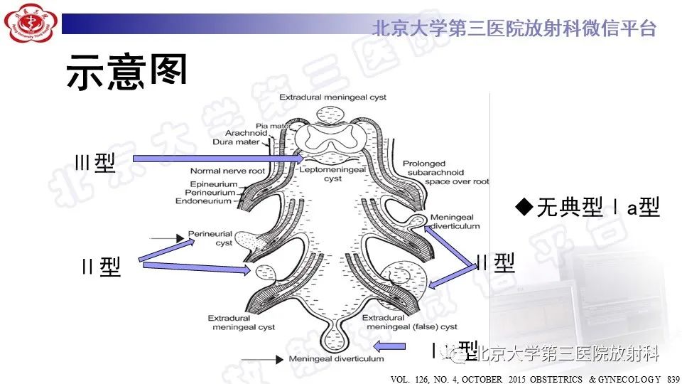 【PPT】椎管内脊膜囊肿-18