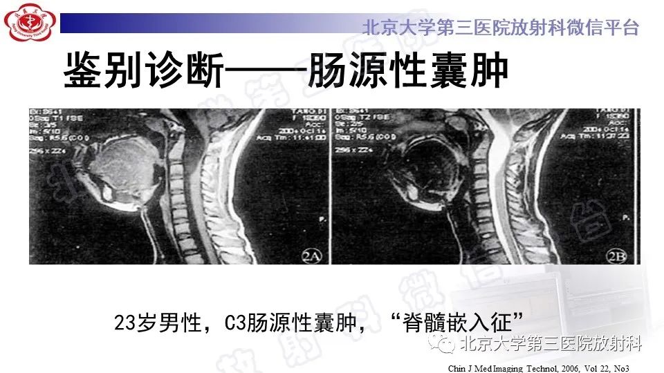 【PPT】椎管内脊膜囊肿-42