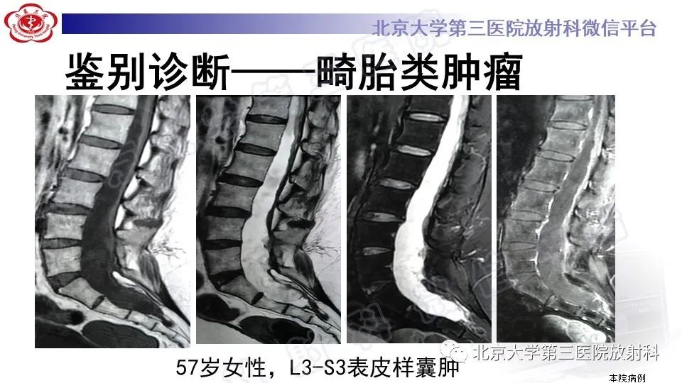 【PPT】椎管内脊膜囊肿-39