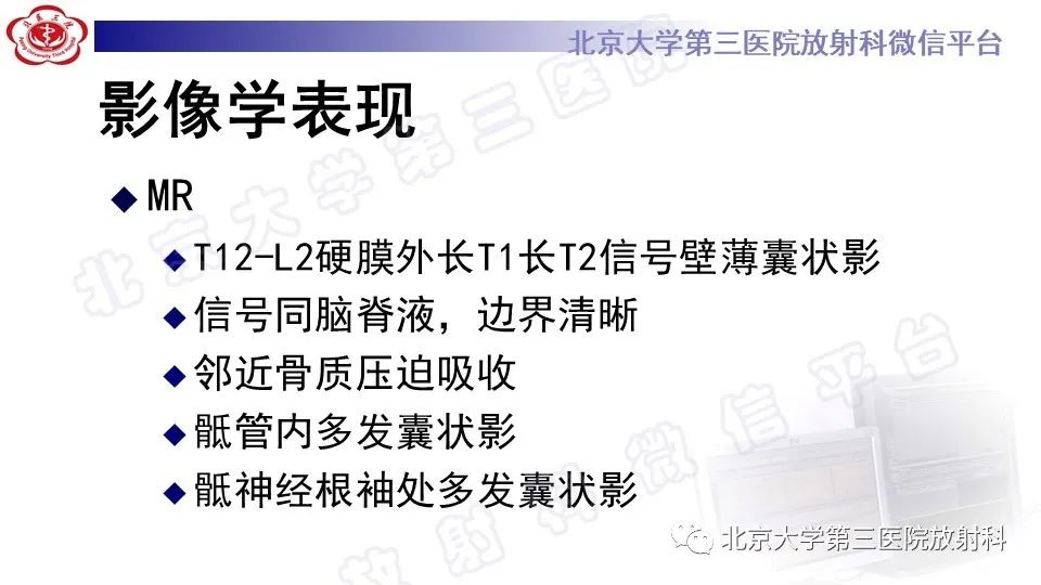 【PPT】椎管内脊膜囊肿-11