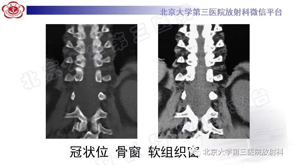 【PPT】椎管内脊膜囊肿-6