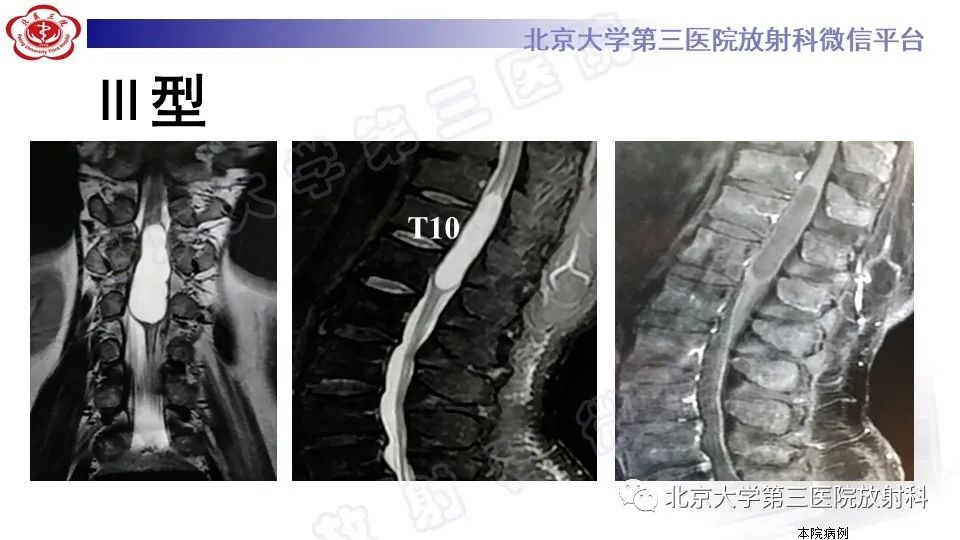 【PPT】椎管内脊膜囊肿-34