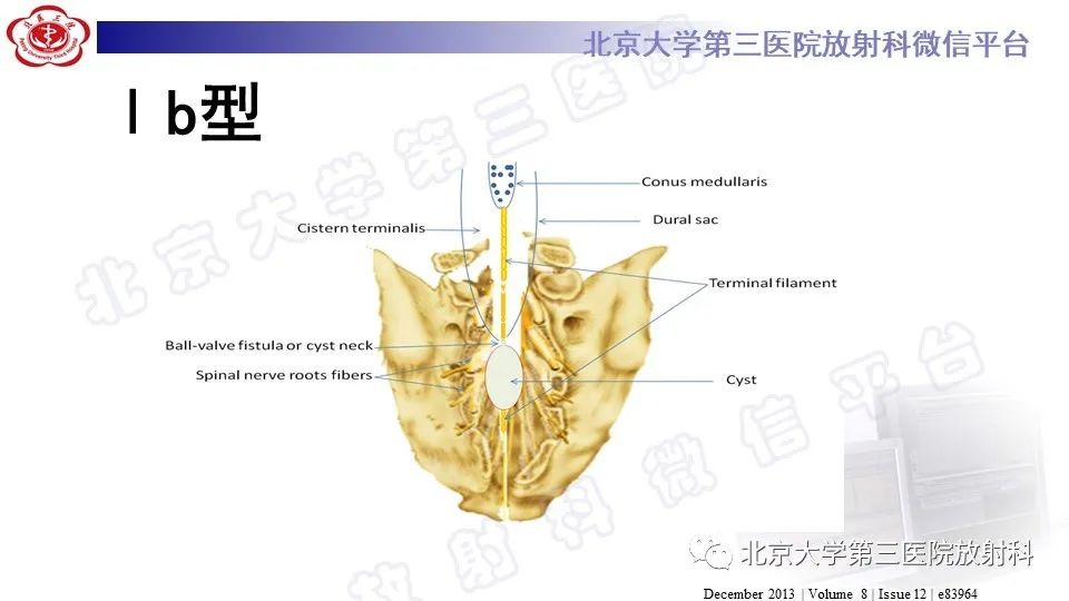 【PPT】椎管内脊膜囊肿-25