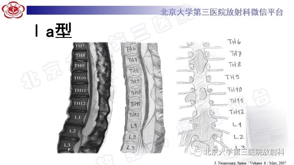 【PPT】椎管内脊膜囊肿-22