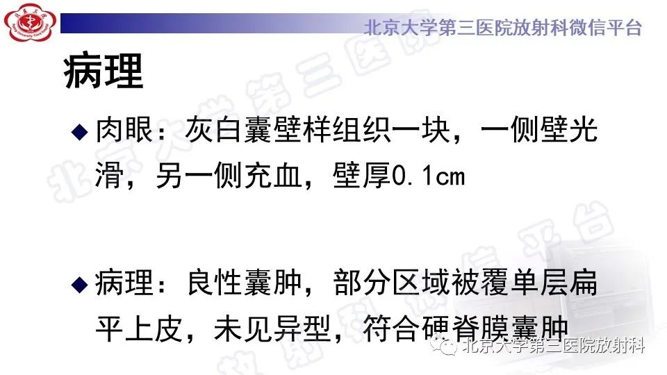 【PPT】椎管内脊膜囊肿-13