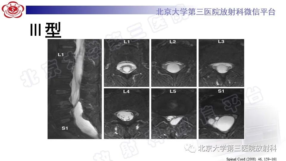 【PPT】椎管内脊膜囊肿-33