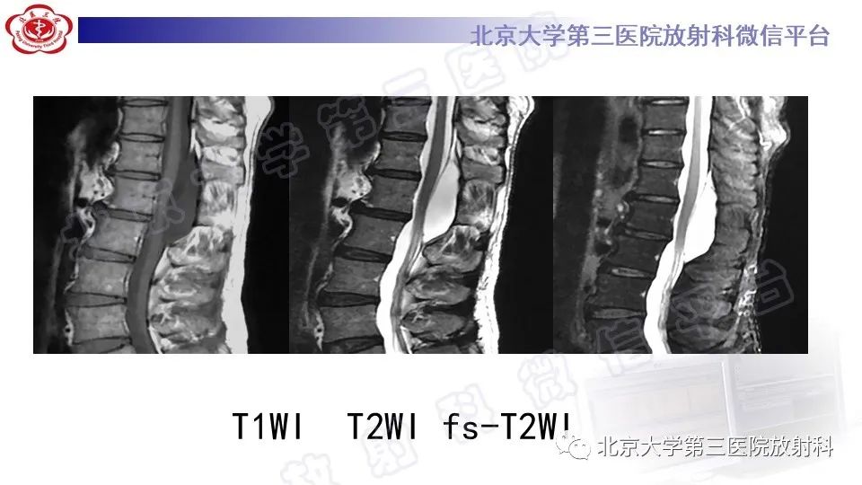【PPT】椎管内脊膜囊肿-8