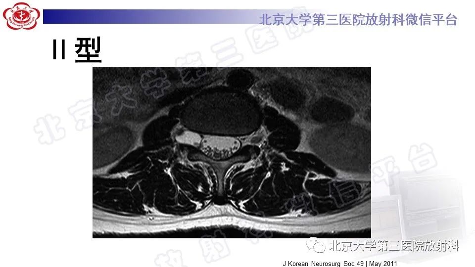 【PPT】椎管内脊膜囊肿-30
