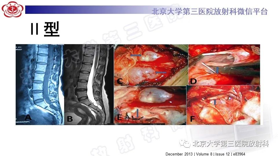 【PPT】椎管内脊膜囊肿-29