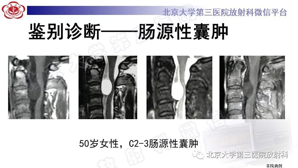 【PPT】椎管内脊膜囊肿-41