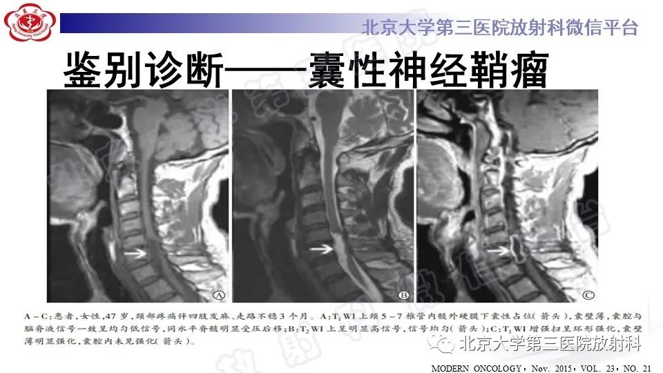 【PPT】椎管内脊膜囊肿-44