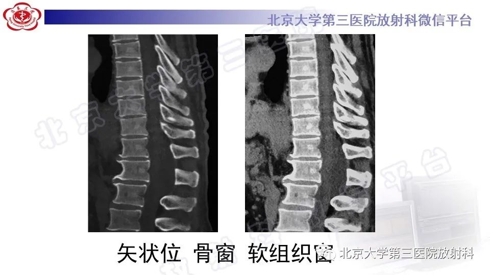 【PPT】椎管内脊膜囊肿-5