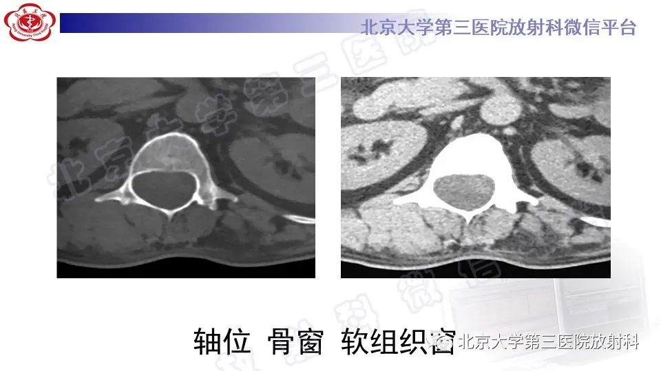 【PPT】椎管内脊膜囊肿-4